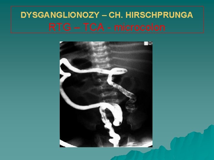 DYSGANGLIONOZY – CH. HIRSCHPRUNGA RTG – TCA - microcolon 