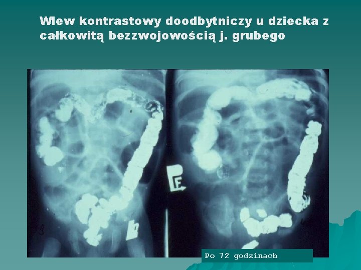 Wlew kontrastowy doodbytniczy u dziecka z całkowitą bezzwojowością j. grubego Obraz po 24 godzinach