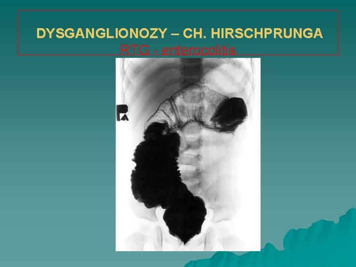 DYSGANGLIONOZY – CH. HIRSCHPRUNGA RTG - enterocolitis 