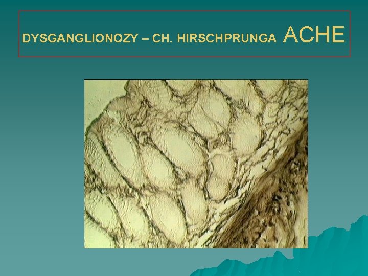 DYSGANGLIONOZY – CH. HIRSCHPRUNGA ACHE 