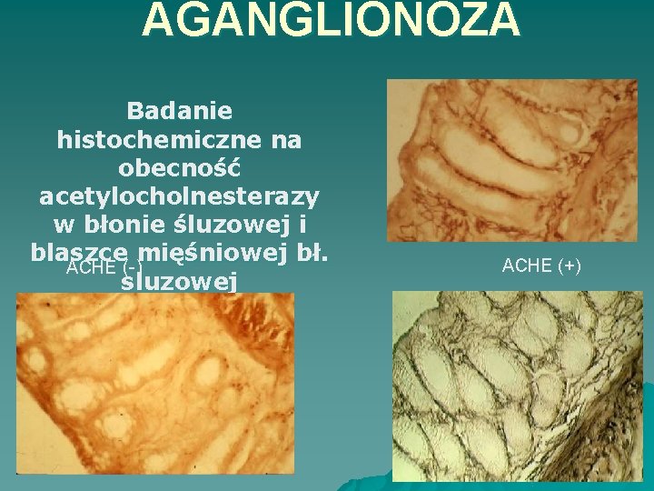 AGANGLIONOZA Badanie histochemiczne na obecność acetylocholnesterazy w błonie śluzowej i blaszce mięśniowej bł. ACHE
