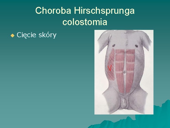 Choroba Hirschsprunga colostomia u Cięcie skóry 