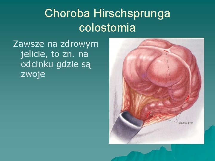 Choroba Hirschsprunga colostomia Zawsze na zdrowym jelicie, to zn. na odcinku gdzie są zwoje