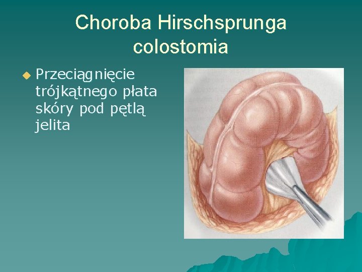 Choroba Hirschsprunga colostomia u Przeciągnięcie trójkątnego płata skóry pod pętlą jelita 