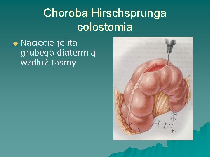 Choroba Hirschsprunga colostomia u Nacięcie jelita grubego diatermią wzdłuż taśmy 