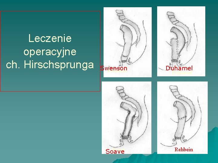 Leczenie operacyjne ch. Hirschsprunga Swenson Soave Duhamel Rehbein 