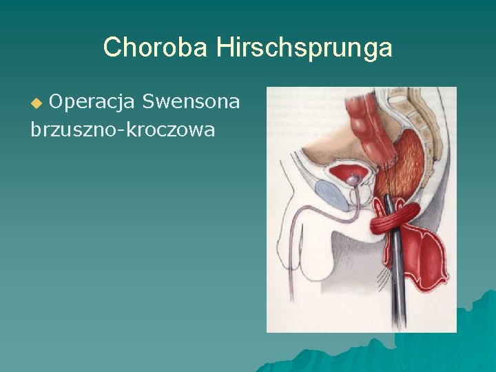 Choroba Hirschsprunga Operacja Swensona brzuszno-kroczowa u 