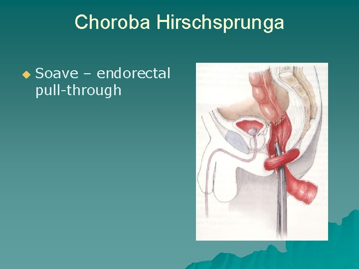 Choroba Hirschsprunga u Soave – endorectal pull-through 