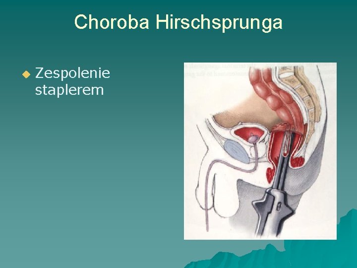 Choroba Hirschsprunga u Zespolenie staplerem 