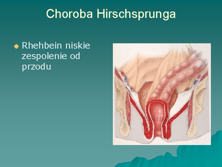 Choroba Hirschsprunga u Rhehbein niskie zespolenie od przodu 