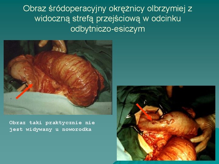 Obraz śródoperacyjny okrężnicy olbrzymiej z widoczną strefą przejściową w odcinku odbytniczo-esiczym Obraz taki praktycznie