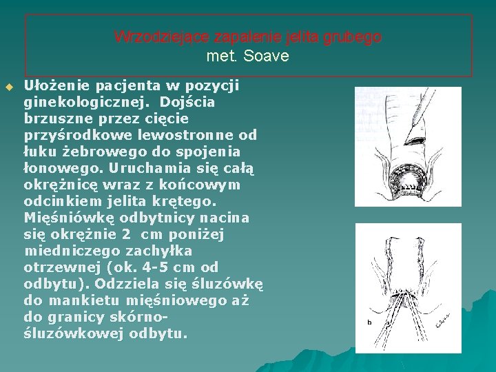 Wrzodziejące zapalenie jelita grubego met. Soave u Ułożenie pacjenta w pozycji ginekologicznej. Dojścia brzuszne