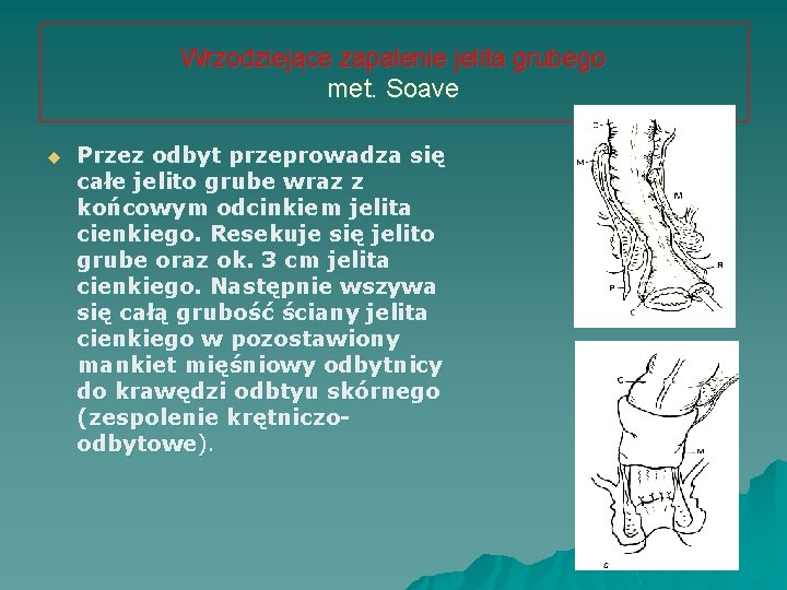 Wrzodziejące zapalenie jelita grubego met. Soave u Przez odbyt przeprowadza się całe jelito grube