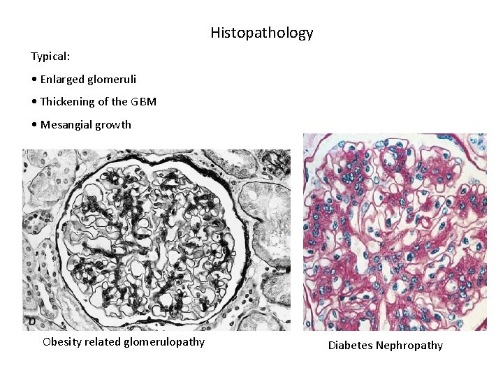 Histopathology Typical: • Enlarged glomeruli • Thickening of the GBM • Mesangial growth Obesity