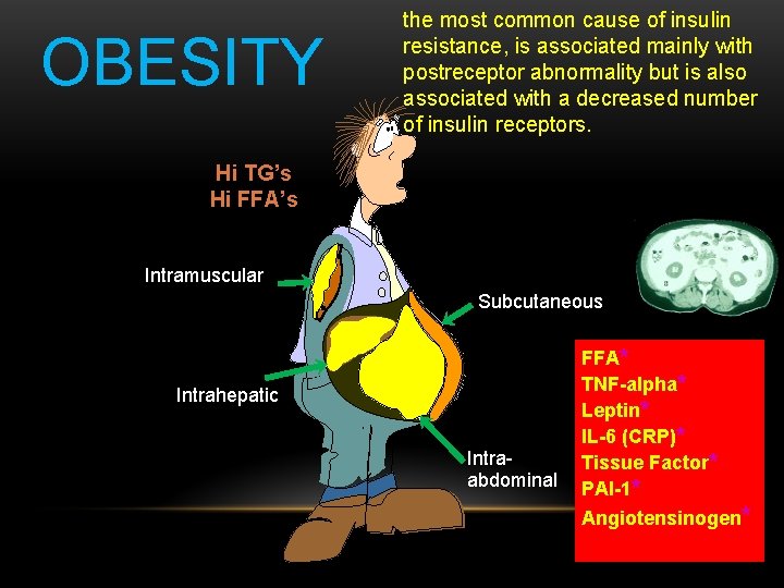OBESITY the most common cause of insulin resistance, is associated mainly with postreceptor abnormality