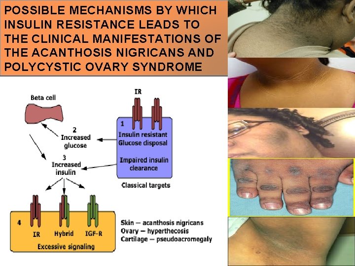 POSSIBLE MECHANISMS BY WHICH INSULIN RESISTANCE LEADS TO THE CLINICAL MANIFESTATIONS OF THE ACANTHOSIS