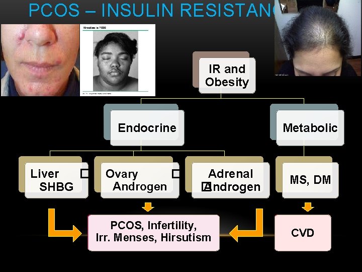 PCOS – INSULIN RESISTANCE IR and Obesity Endocrine Liver � SHBG Ovary � Androgen