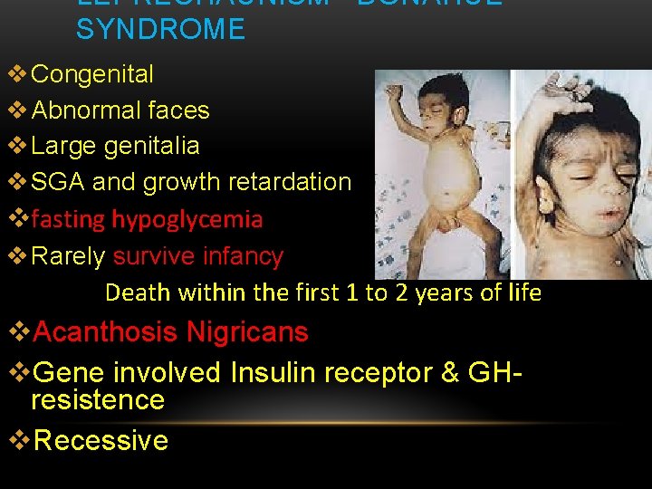 LEPRECHAUNISM –DONAHUE SYNDROME v Congenital v Abnormal faces v Large genitalia v SGA and