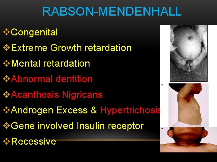 RABSON-MENDENHALL v. Congenital v. Extreme Growth retardation v. Mental retardation v. Abnormal dentition v.