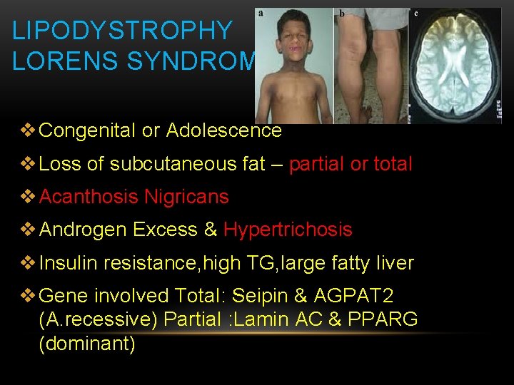 LIPODYSTROPHY LORENS SYNDROME v Congenital or Adolescence v Loss of subcutaneous fat – partial