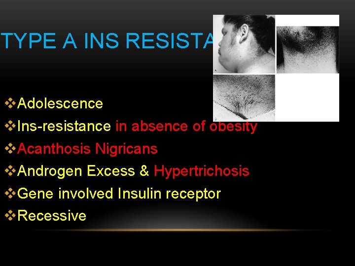 TYPE A INS RESISTANCE v. Adolescence v. Ins-resistance in absence of obesity v. Acanthosis