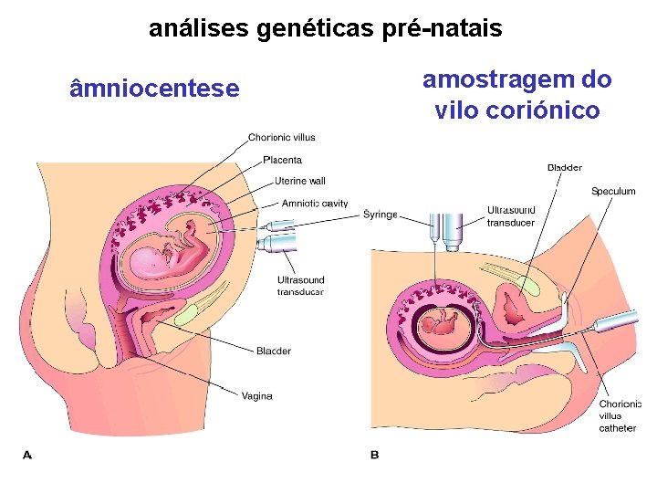 análises genéticas pré-natais âmniocentese amostragem do vilo coriónico 