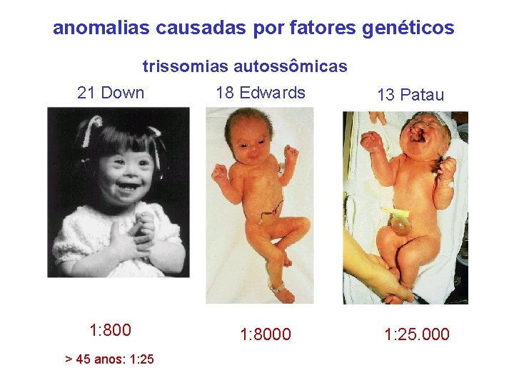 anomalias causadas por fatores genéticos trissomias autossômicas 21 Down 18 Edwards 1: 8000 >