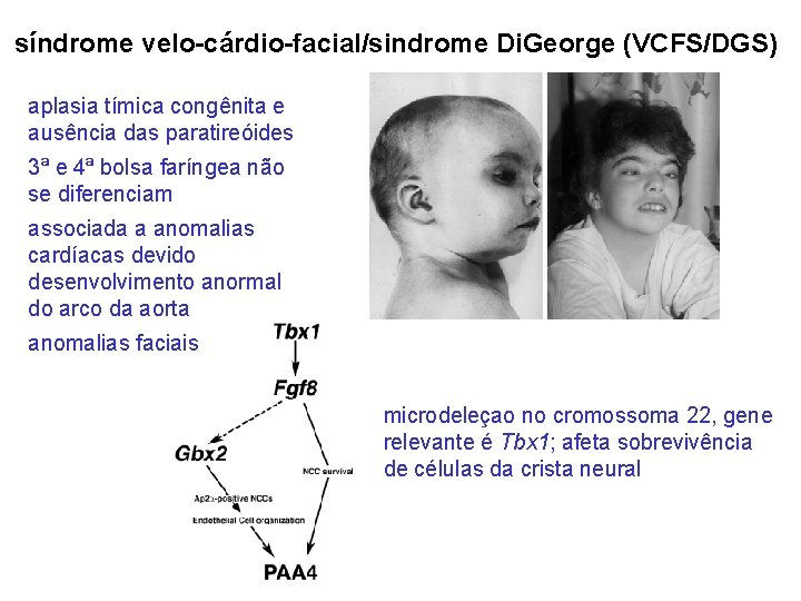síndrome velo-cárdio-facial/sindrome Di. George (VCFS/DGS) aplasia tímica congênita e ausência das paratireóides 3ª e