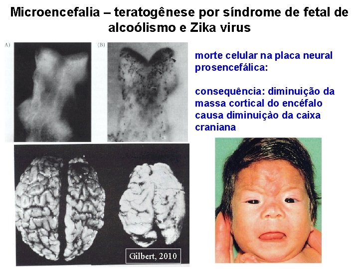 Microencefalia – teratogênese por síndrome de fetal de alcoólismo e Zika virus morte celular