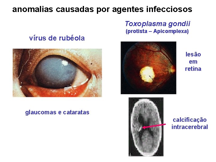 anomalias causadas por agentes infecciosos Toxoplasma gondii vírus de rubéola (protista – Apicomplexa) lesão