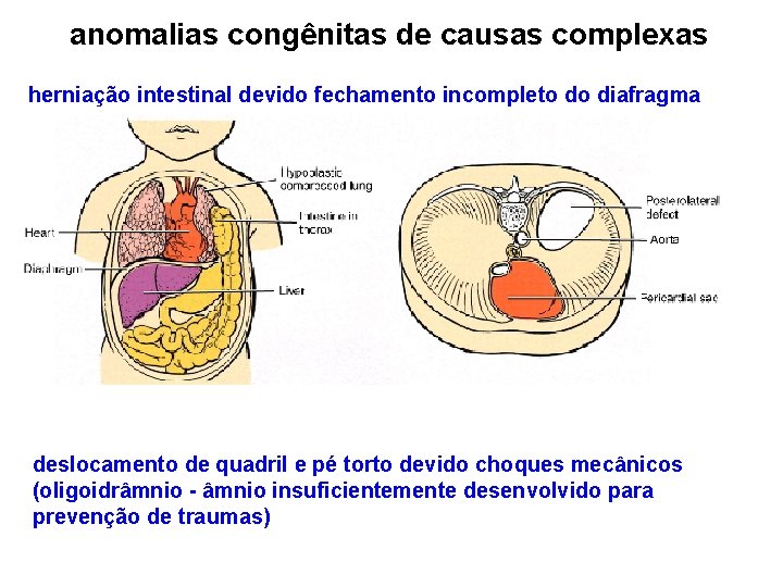 anomalias congênitas de causas complexas herniação intestinal devido fechamento incompleto do diafragma deslocamento de