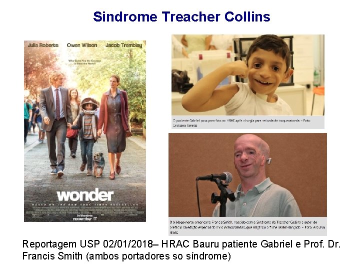 Sindrome Treacher Collins Reportagem USP 02/01/2018– HRAC Bauru patiente Gabriel e Prof. Dr. Francis
