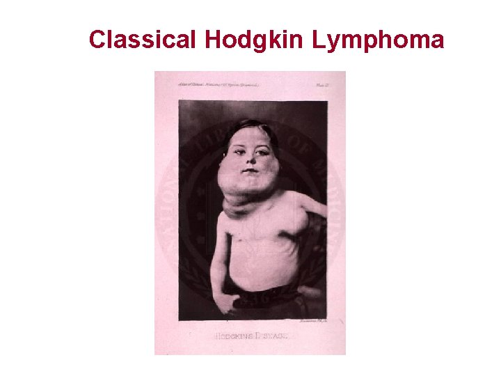 Classical Hodgkin Lymphoma 