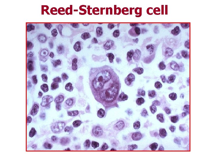 Reed-Sternberg cell 