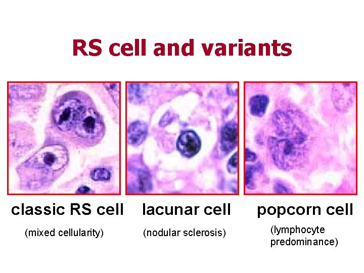RS cell and variants classic RS cell (mixed cellularity) lacunar cell popcorn cell (nodular