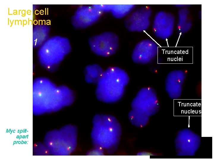 Large cell lymphoma Case 1 Truncated nuclei Truncated nucleus Myc splitapart probe: Probe 1+2