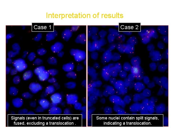 FISH analysis of paraffin embedded tissue Interpretation of results Case 1 Signals (even in