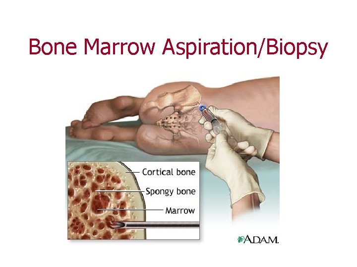 Bone Marrow Aspiration/Biopsy 