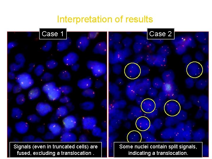 FISH analysis of paraffin embedded tissue Interpretation of results Case 1 Signals (even in