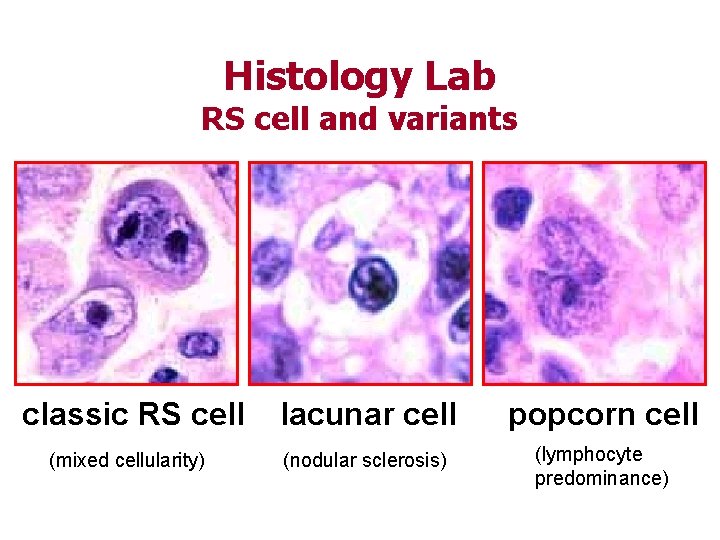 Histology Lab RS cell and variants classic RS cell (mixed cellularity) lacunar cell popcorn