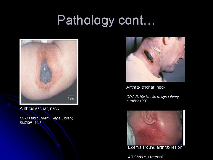 Pathology cont… Anthrax eschar, neck CDC Public Health Image Library, number 1933 Anthrax eschar,