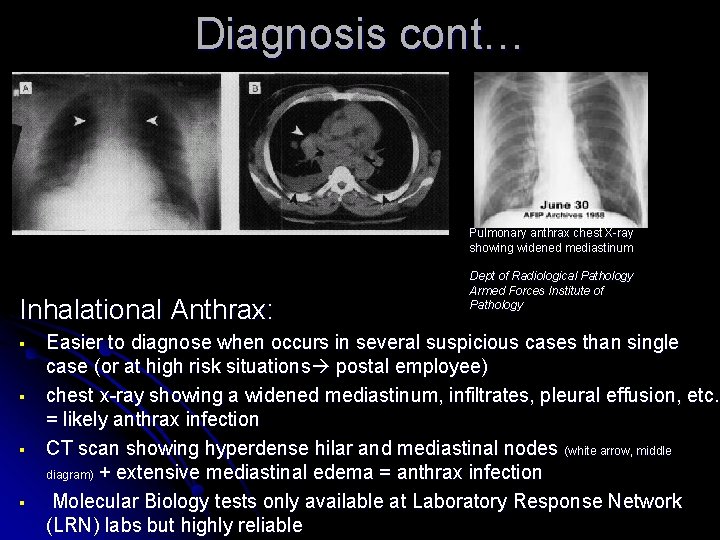 Diagnosis cont… Pulmonary anthrax chest X-ray showing widened mediastinum Inhalational Anthrax: § § Dept