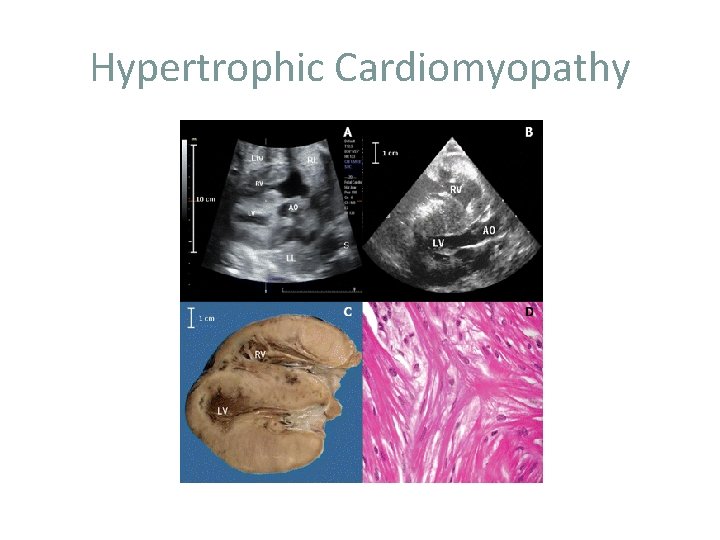 Hypertrophic Cardiomyopathy 