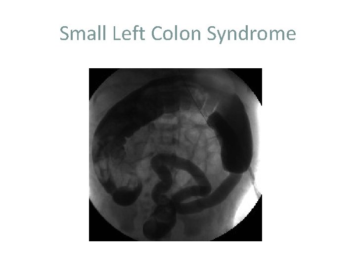 Small Left Colon Syndrome 