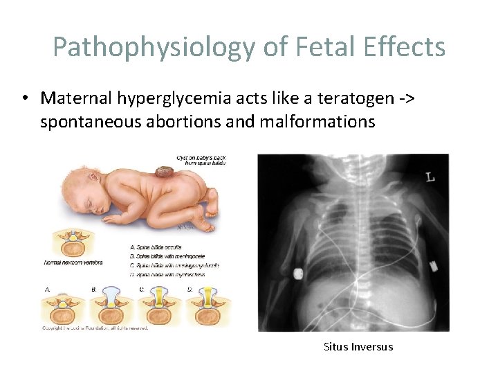 Pathophysiology of Fetal Effects • Maternal hyperglycemia acts like a teratogen -> spontaneous abortions