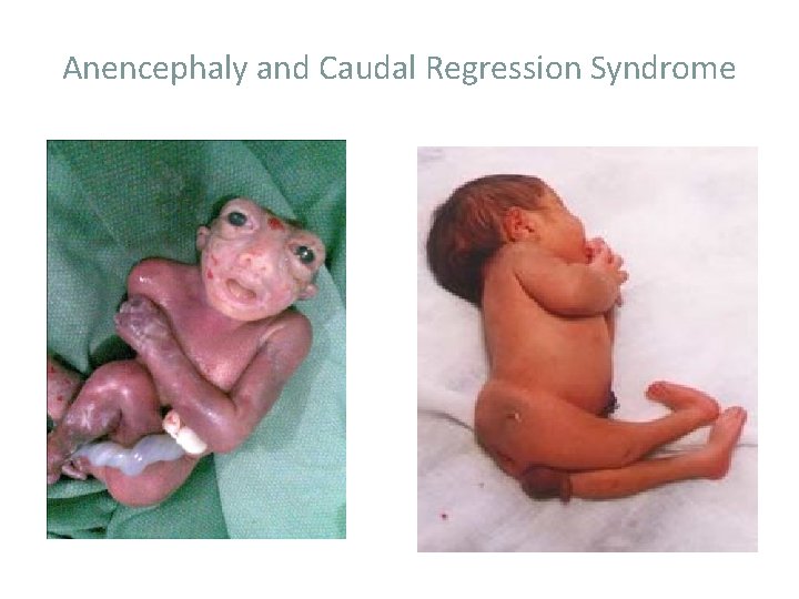 Anencephaly and Caudal Regression Syndrome 