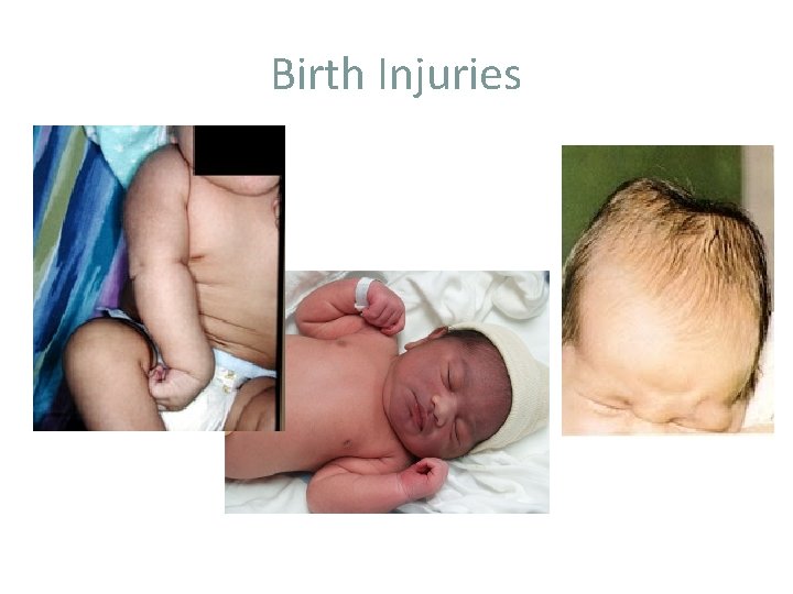 Birth Injuries 