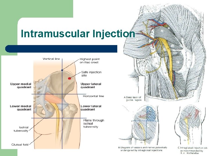 Intramuscular Injection 