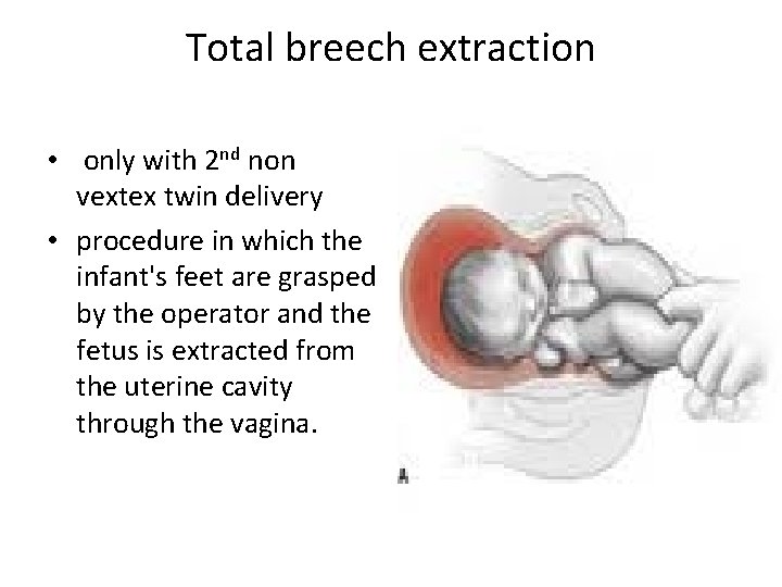 Total breech extraction • only with 2 nd non vextex twin delivery • procedure