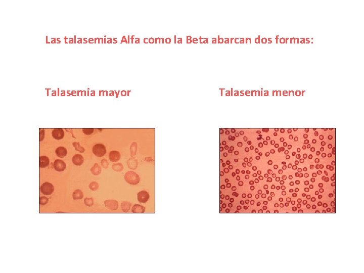 Las talasemias Alfa como la Beta abarcan dos formas: Talasemia mayor Talasemia menor 